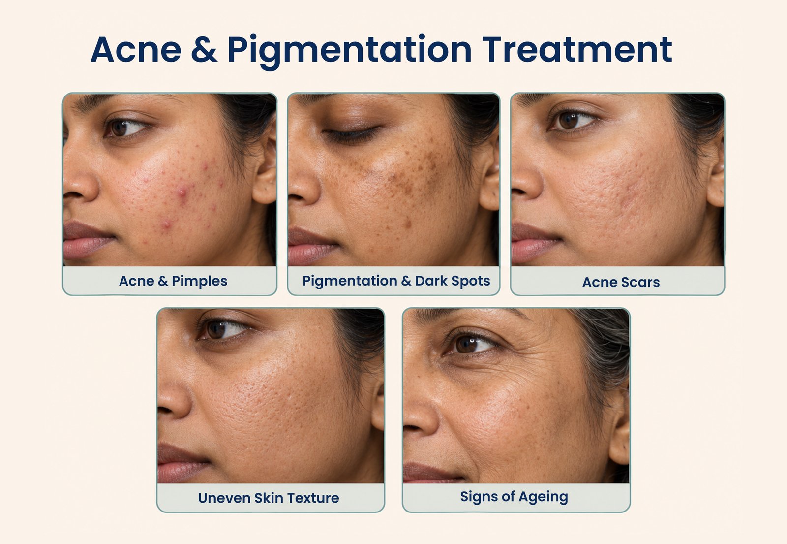 Best Acne Treatment in Delhi